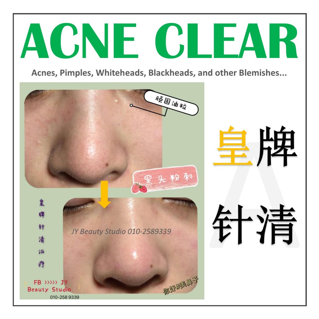 acneclear