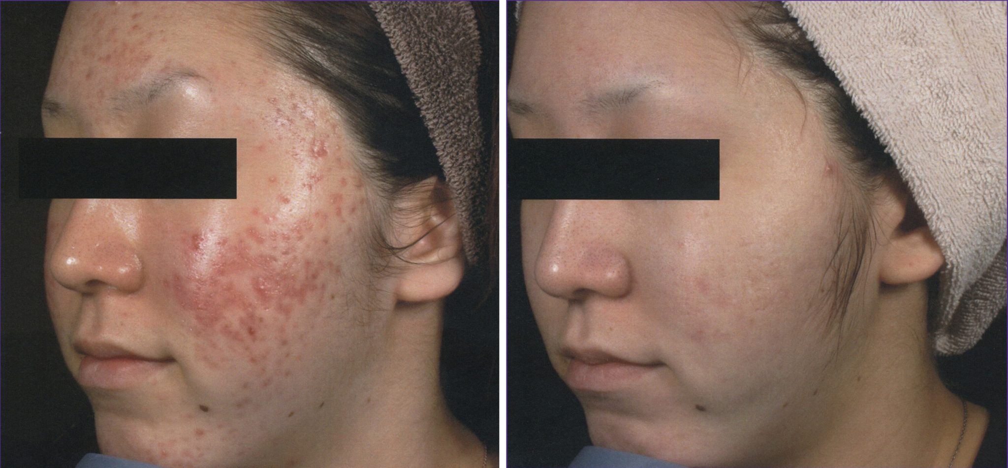 Active Acne Acne Scar Reduction JY Beauty Studio active-acne-acne-scar-reduction-jy-beauty-studio